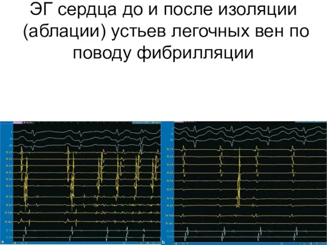 ЭГ сердца до и после изоляции (аблации) устьев легочных вен по поводу фибрилляции