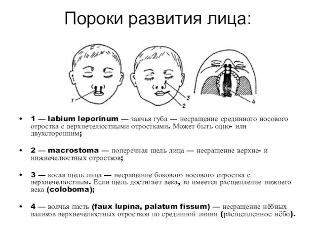 Пороки развития лица: 1 — labium leporinum — заячья губа — несращение