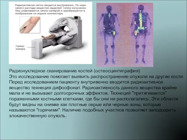 Радионуклидное сканирование костей (остеосцинтиграфия) Это исследование помогает выявить распространение опухоли на другие