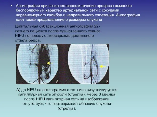 Ангиография при злокачественном течение процесса выявляет беспорядочный характер артериальной сети с сосудами