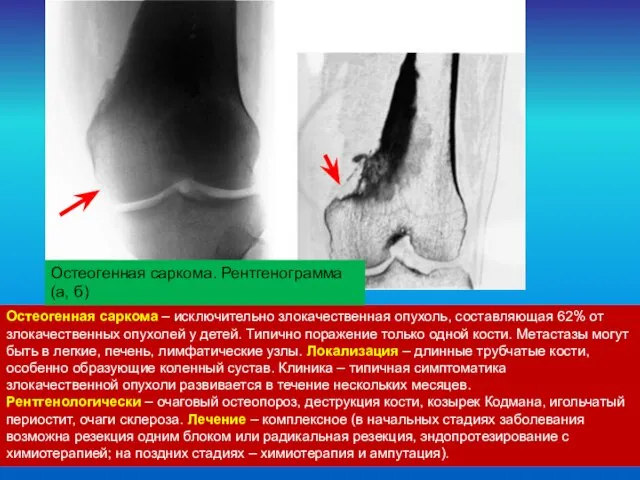 Остеогенная саркома – исключительно злокачественная опухоль, составляющая 62% от злокачественных опухолей у