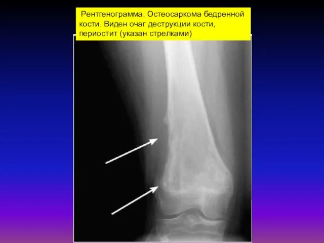 Рентгенограмма. Остеосаркома бедренной кости. Виден очаг деструкции кости, периостит (указан стрелками)