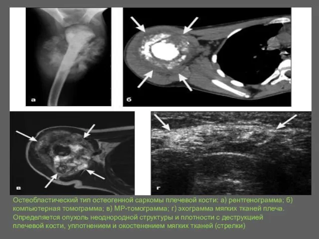 Остеобластический тип остеогенной саркомы плечевой кости: а) рентгенограмма; б) компьютерная томограмма; в)