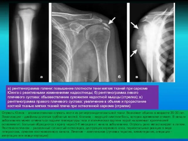 а) рентгенограмма голени: повышение плотности тени мягких тканей при саркоме Юинга с