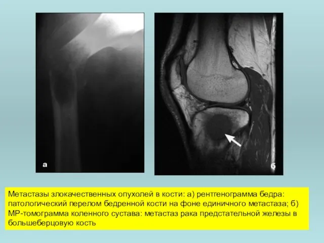 Метастазы злокачественных опухолей в кости: а) рентгенограмма бедра: патологический перелом бедренной кости