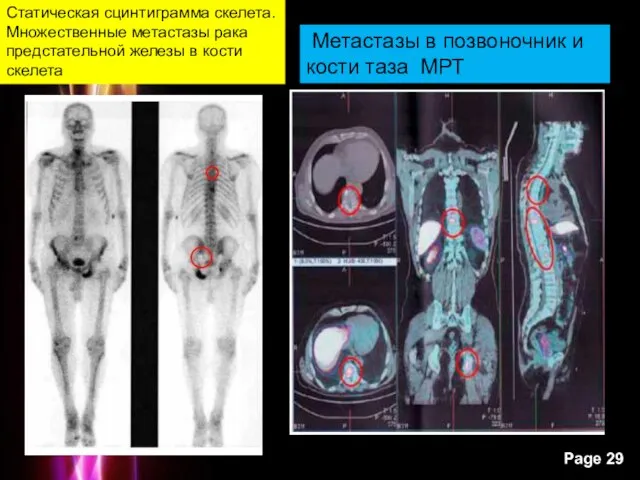 Статическая сцинтиграмма скелета. Множественные метастазы рака предстательной железы в кости скелета Метастазы