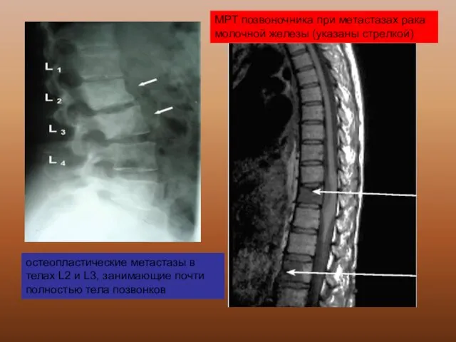 остеопластические метастазы в телах L2 и L3, занимающие почти полностью тела позвонков