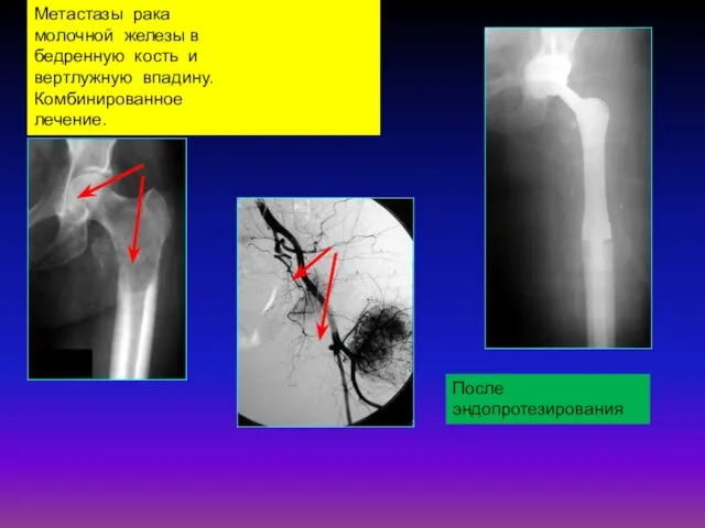 Метастазы рака молочной железы в бедренную кость и вертлужную впадину. Комбинированное лечение. После эндопротезирования