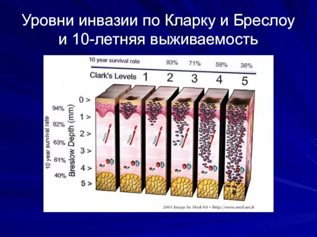 Уровни инвазии по Кларку и Бреслоу и 10-летняя выживаемость