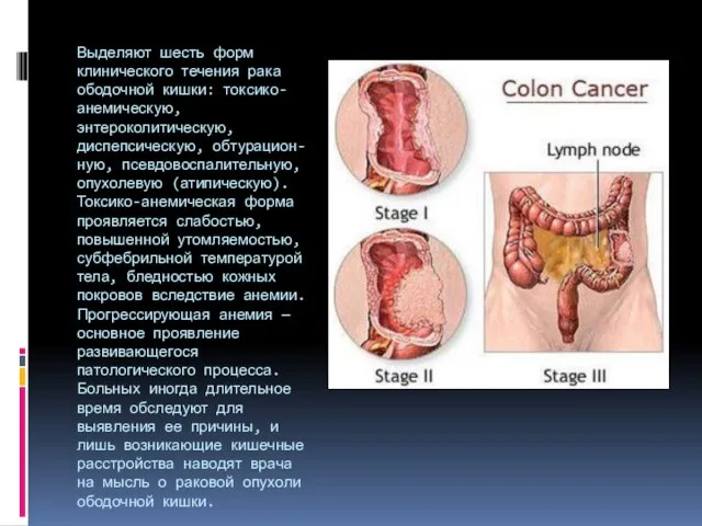 Выделяют шесть форм клинического течения рака ободочной кишки: токсико-анемическую, энтероколитическую, диспепсическую, обтурацион-ную,