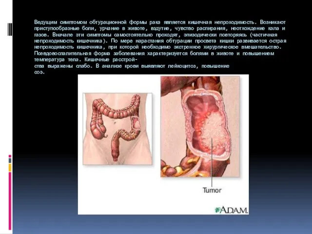 Ведущим симптомом обтурационной формы рака является ки­шечная непроходимость. Возникают приступообразные боли, урчание