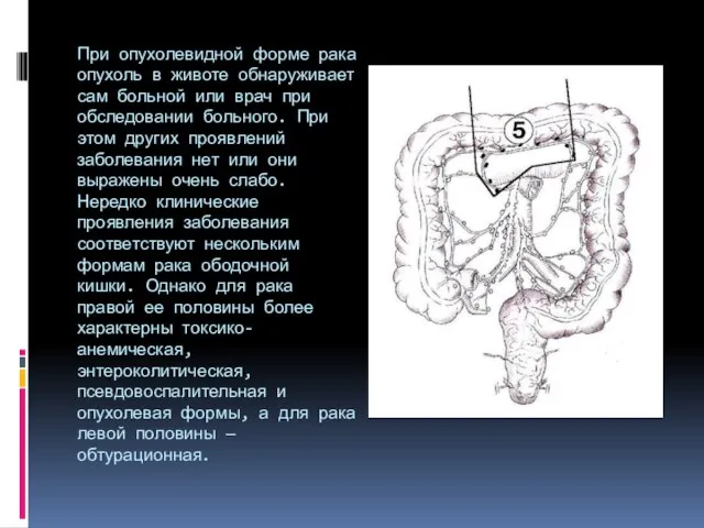 При опухолевидной форме рака опухоль в животе обнаруживает сам больной или врач