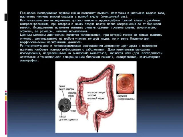 Пальцевое исследование прямой кишки позволяет выявить метастазы в клетчатке малого таза, исключить