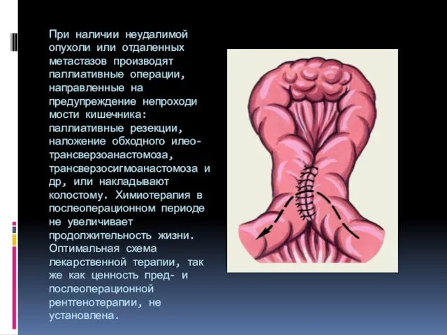 При наличии неудалимой опухоли или отдаленных метастазов произво­дят паллиативные операции, направленные на