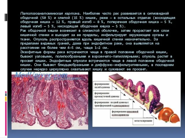 Патологоанатоммеская картина. Наиболее часто рак развивается в сиг­мовидной ободочной (50 %) и