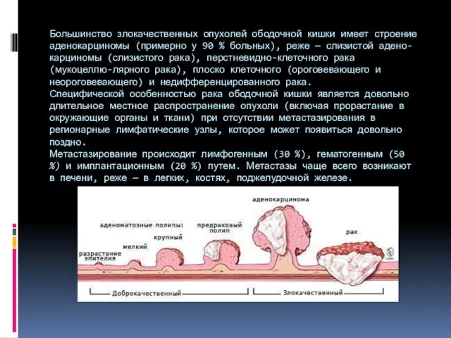 Большинство злокачественных опухолей ободочной кишки имеет строе­ние аденокарциномы (примерно у 90 %