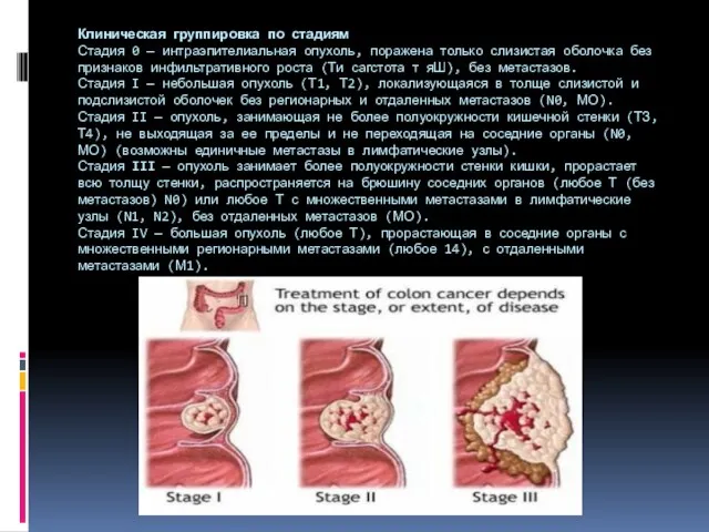 Клиническая группировка по стадиям Стадия 0 — интраэпителиальная опухоль, поражена только слизистая