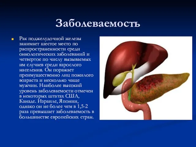 Заболеваемость Рак поджелудочной железы занимает шестое место по распространенности среди онкологических заболеваний