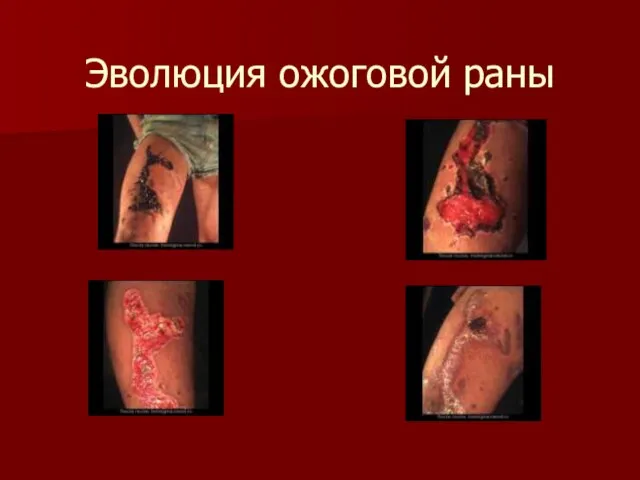 Эволюция ожоговой раны