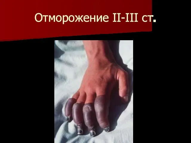 Отморожение II-III ст.