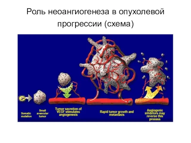 Роль неоангиогенеза в опухолевой прогрессии (схема)