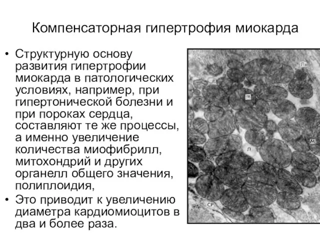 Компенсаторная гипертрофия миокарда Структурную основу развития гипертрофии миокарда в патологических условиях, например,