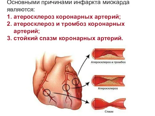 Основными причинами инфаркта миокарда являются: 1. атеросклероз коронарных артерий; 2. атеросклероз и