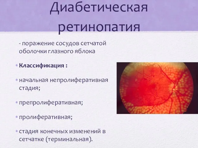 Диабетическая ретинопатия - поражение сосудов сетчатой оболочки глазного яблока Классификация : начальная