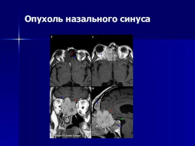 Опухоль назального синуса