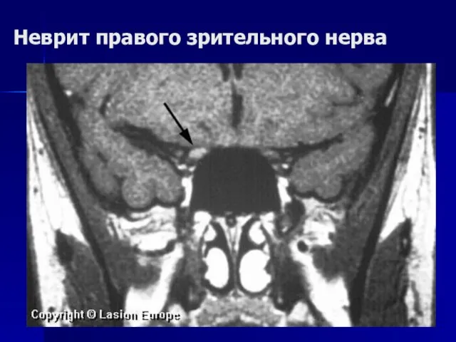 Неврит правого зрительного нерва