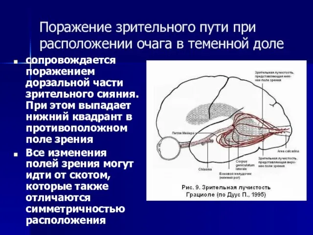 Поражение зрительного пути при расположении очага в теменной доле сопровождается поражением дорзальной