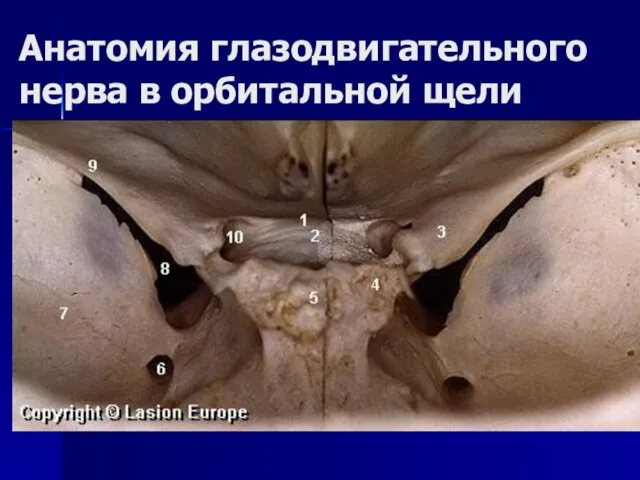 Анатомия глазодвигательного нерва в орбитальной щели