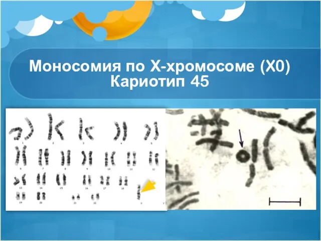 Моносомия по Х-хромосоме (X0) Кариотип 45