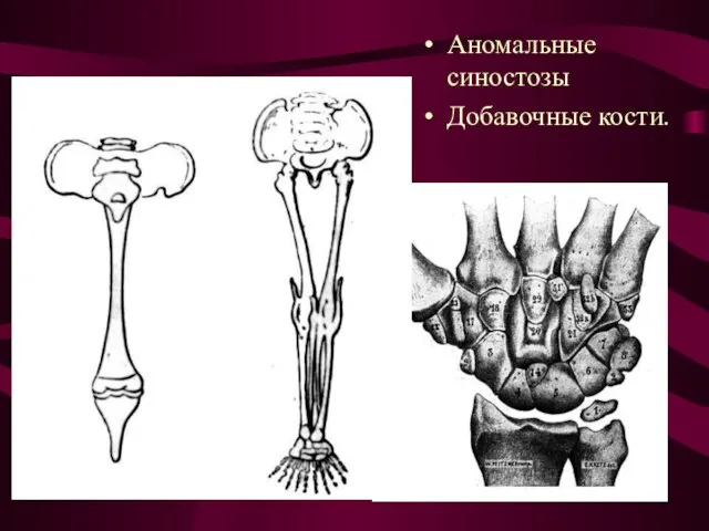 Аномальные синостозы Добавочные кости.