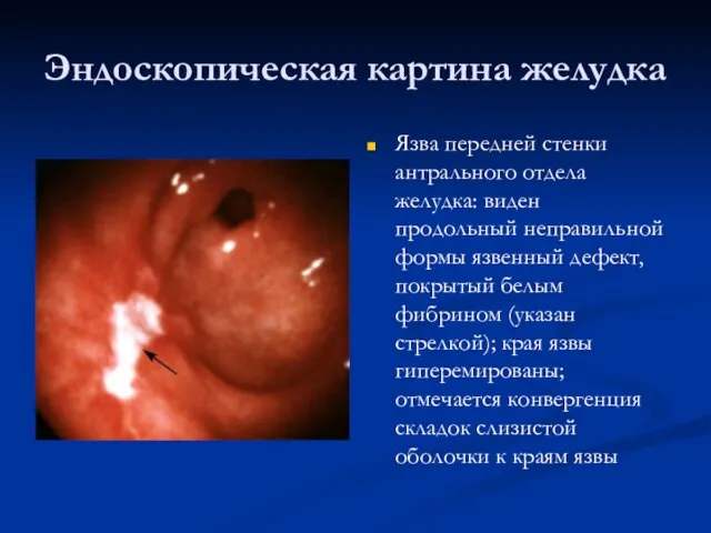 Эндоскопическая картина желудка Язва передней стенки антрального отдела желудка: виден продольный неправильной