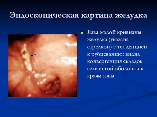 Эндоскопическая картина желудка Язва малой кривизны желудка (указана стрелкой) с тенденцией к