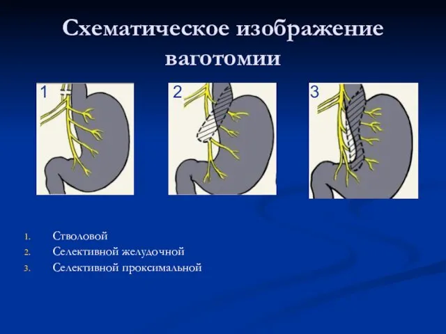 Схематическое изображение ваготомии Стволовой Селективной желудочной Селективной проксимальной 1 2 3