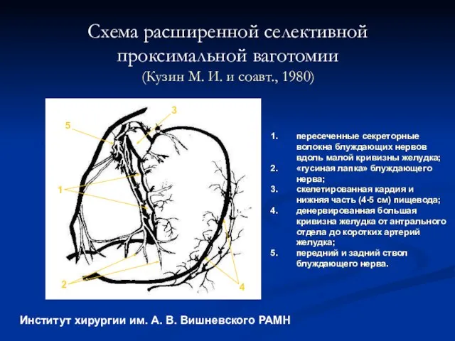 Схема расширенной селективной проксимальной ваготомии (Кузин М. И. и соавт., 1980) Институт