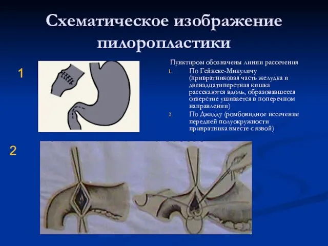 Схематическое изображение пилоропластики Пунктиром обозначены линии рассечения По Гейнеке-Микуличу (привратниковая часть желудка