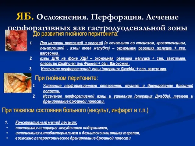 ЯБ. Осложнения. Перфорация. Лечение перфоративных язв гастродуоденальной зоны При наличии показаний и