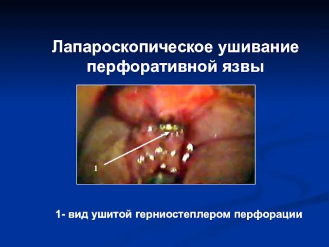 Лапароскопическое ушивание перфоративной язвы 1 1- вид ушитой герниостеплером перфорации
