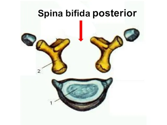 Spina bifida posterior