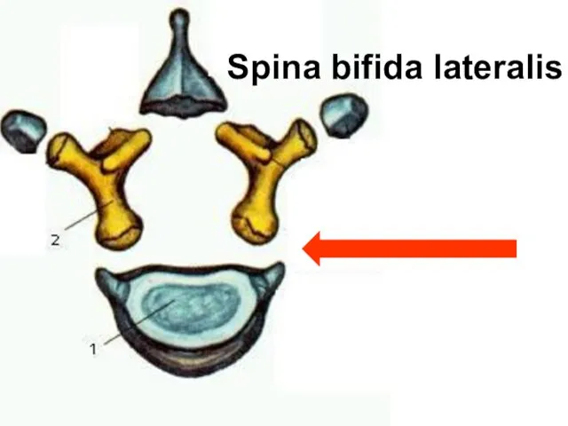 Spina bifida lateralis