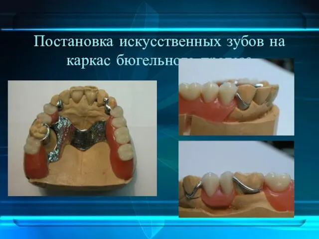 Постановка искусственных зубов на каркас бюгельного протеза