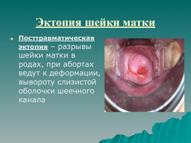 Эктопия шейки матки Посттравматическая эктопия – разрывы шейки матки в родах, при