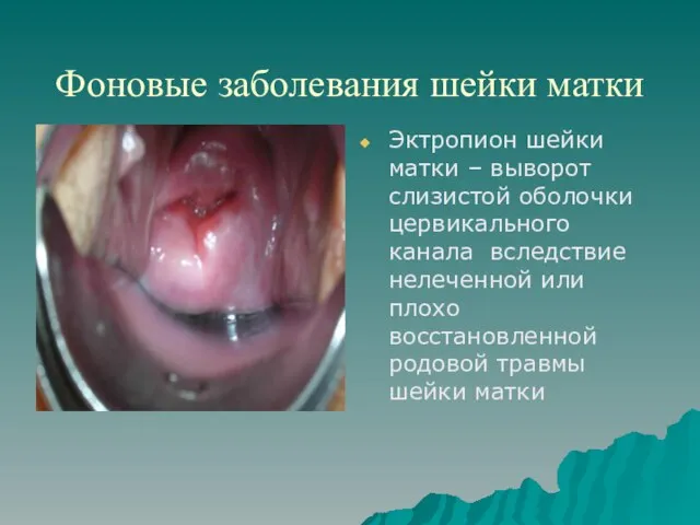 Фоновые заболевания шейки матки Эктропион шейки матки – выворот слизистой оболочки цервикального