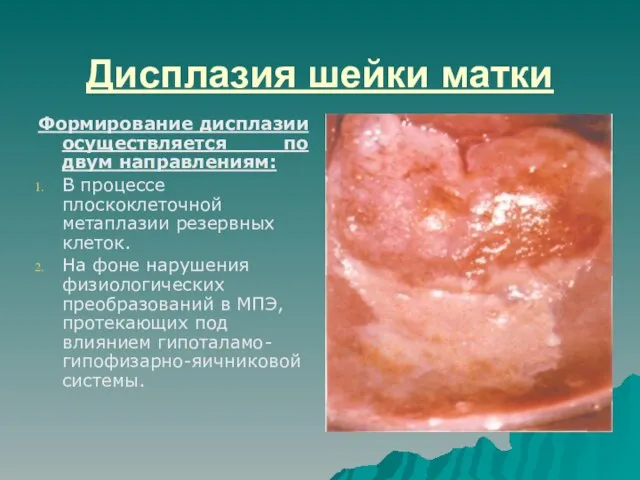 Дисплазия шейки матки Формирование дисплазии осуществляется по двум направлениям: В процессе плоскоклеточной