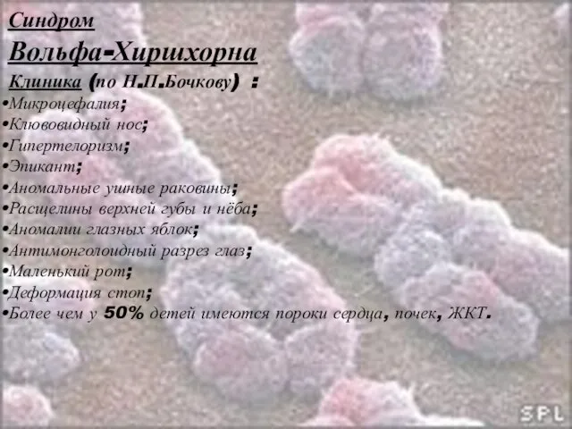 Синдром Вольфа-Хиршхорна Клиника (по Н.П.Бочкову) : Микроцефалия; Клювовидный нос; Гипертелоризм; Эпикант; Аномальные