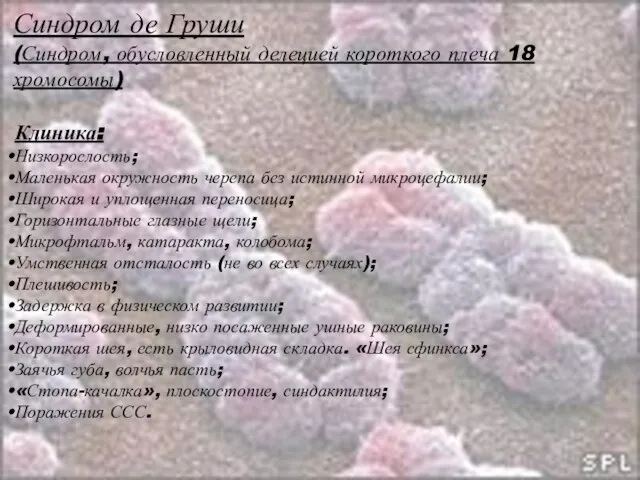 Синдром де Груши (Синдром, обусловленный делецией короткого плеча 18 хромосомы) Клиника: Низкорослость;