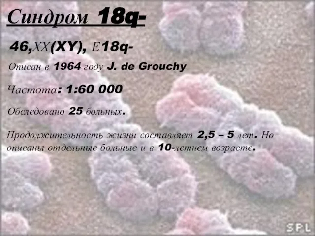 Синдром 18q- Частота: 1:60 000 Обследовано 25 больных. Продолжительность жизни составляет 2,5